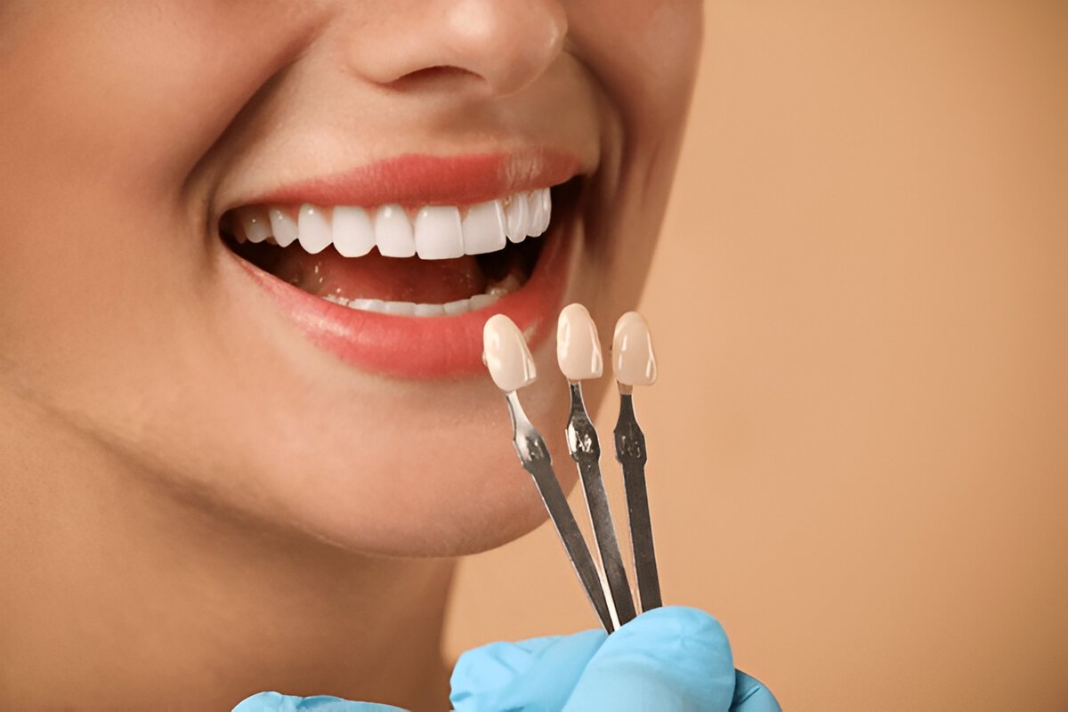 porcelain veneers tailored