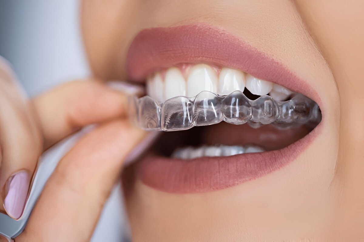 Veneers Fort Saskatchewan