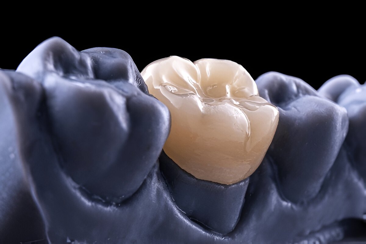 Dental Crowns Fort Saskatchewan
