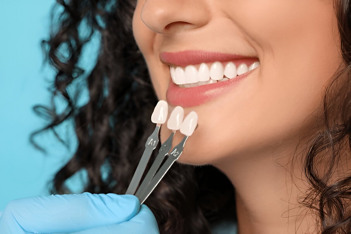 Veneers Fort Saskatchewan