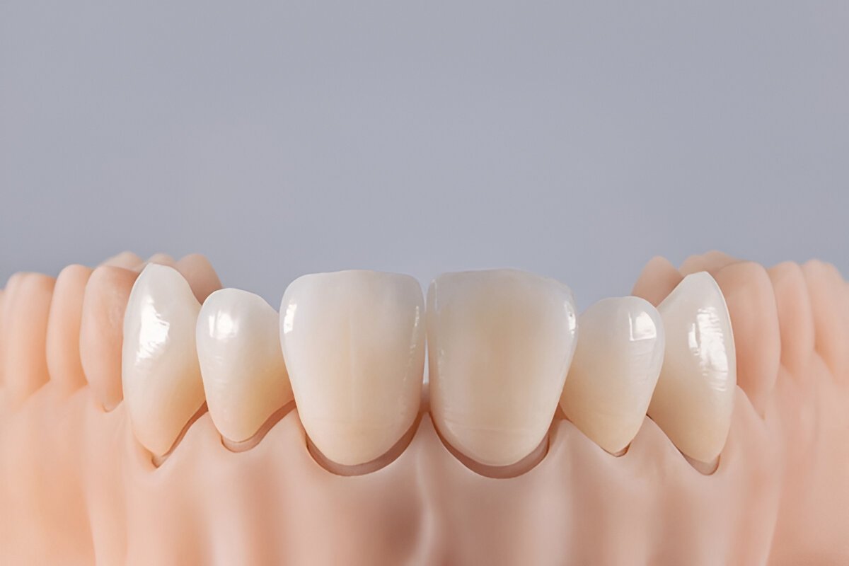 Dental Crowns Fort Saskatchewan